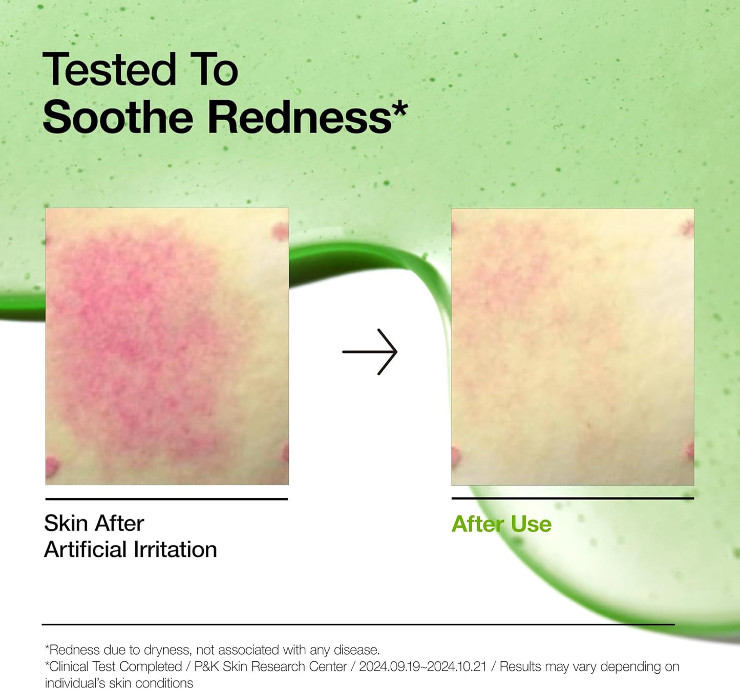 Anua Azelaic Acid 10 Hyaluron Redness Soothing Serum -  Facial Serum for Sensitive skin, Hyaluronic Acid, Niacinamide, Spot Care, Natural Color, Vegan, Korean Skincare 30ml